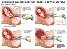 Realizarea avortului